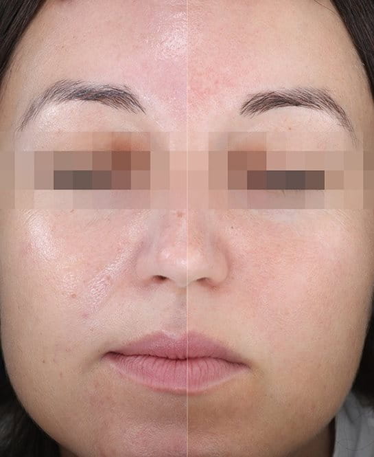 Lice žene pre nanošenja jednog i drugog preparata na po jednu polovinu lica