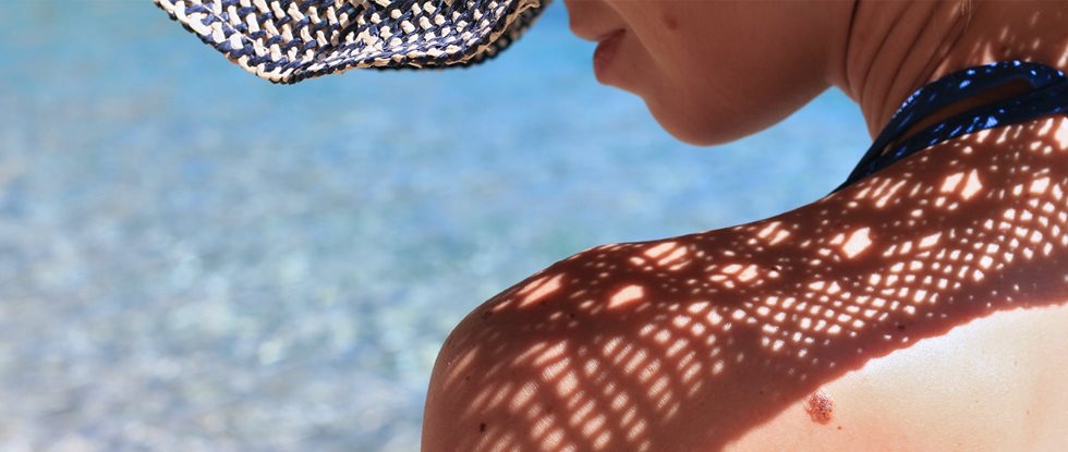 Osetljiva koža na suncu i zaštita od sunca
