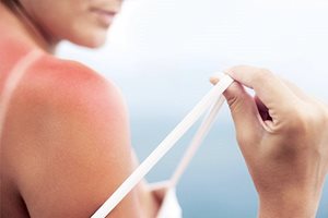 Kako lečiti opekotinu