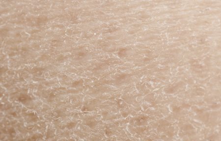 Krupan plan suve kože